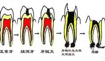 牙周炎的治疗方法偏方 治疗牙周炎的7个简单偏方