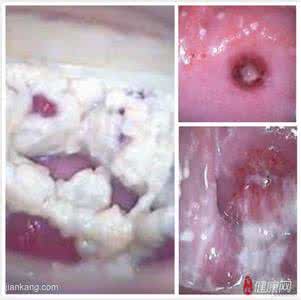 怀孕几天白带有变化吗 怀孕初期白带有什么变化