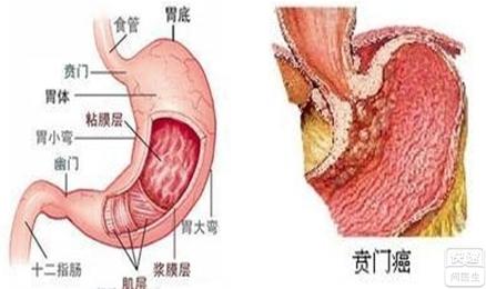 贲门癌化疗方案 贲门癌化疗有用吗 贲门癌注射白蛋白有用吗？