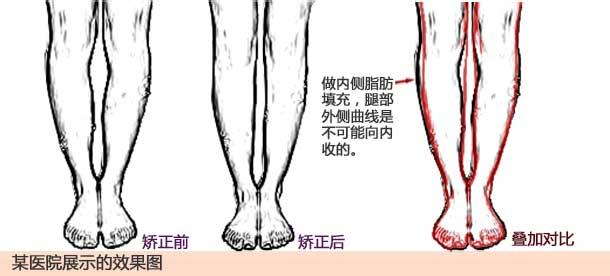 绑腿矫正o型腿3个月图 O型、X型腿矫正形状简介