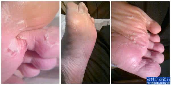 治疗脚气脚臭的方法 治疗脚气脚臭的方法 6种方法治疗脚气脚臭