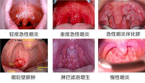 慢性咽炎 锻炼 治疗慢性心肌炎 80%心肌炎伴随慢性咽炎 加强锻炼可防心肌炎