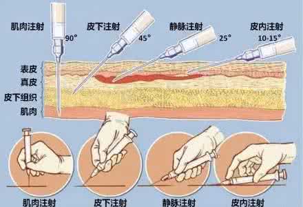 肌肉注射不良反应 肌肉注射局部反应3方