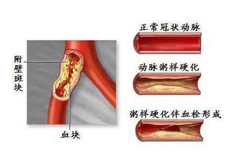 心脑血管疾病治疗方法 心脑血管疾病怎么办呢？有什么好的治疗方法吗？