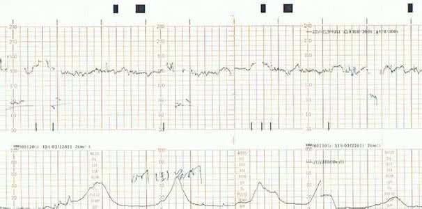 胎心监护不好的原因 胎心监护不好的表现