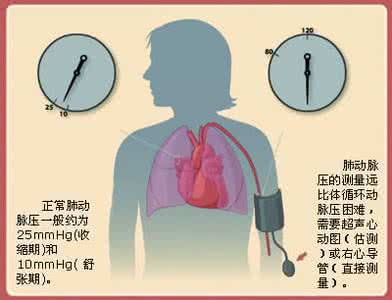 肺动脉高压 血液检测未来有望预测肺动脉高压严重程度