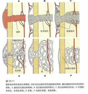 骨折愈合的基本过程 骨折愈合过程 骨折愈合的整体过程