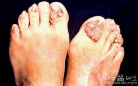 结节性硬化症的症状 结节性硬化症的症状 结节性硬化的症状是什么