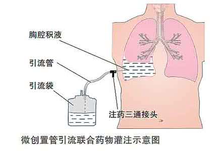 少量胸腔积液怎么办 胸腔积液的病因 恶性胸腔积液怎么办