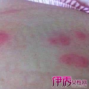 疱疹病毒感染 疱疹病毒感染 身上起红疙瘩很痒怎么办