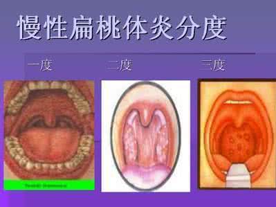 慢性扁桃体炎如何根治 儿童慢性扁桃体炎的治疗方法