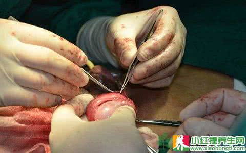 女性结扎的副作用 女性结扎有什么副作用呢？