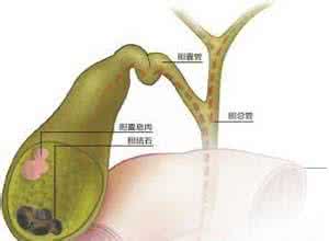 胆囊息肉样病变 胆囊息肉样病变 胆囊息肉样病变如何治疗不容易复发？