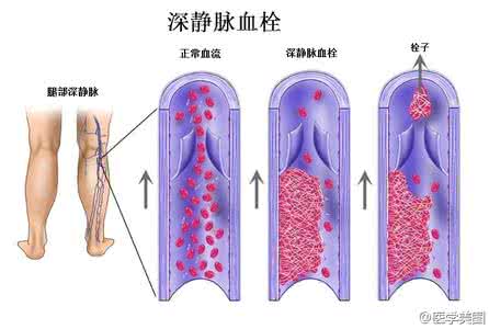 下肢静脉血栓 名医秘方：糖尿病足腰痛下肢静脉血栓百治百愈四味健步汤