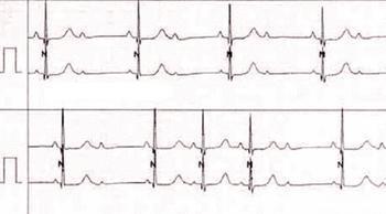 三度房室传导阻滞治疗 二度房室传导阻滞的治疗 应该如何饮食