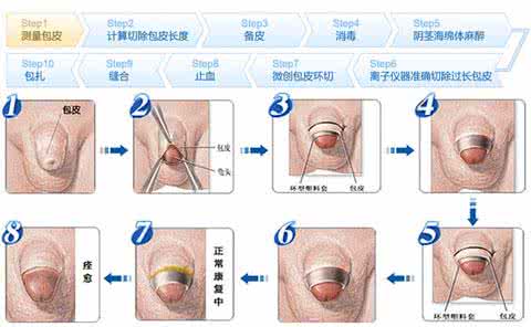 男性做完包皮手术会导致阳痿吗