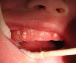 红糖水治疗鹅口疮 红糖可以治疗鹅口疮吗 红糖可以治疗白癜风吗？