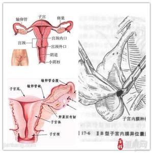 子宫内膜异位症与痛经 痛经子宫内膜异位症 痛经与子宫内膜异位的恋情