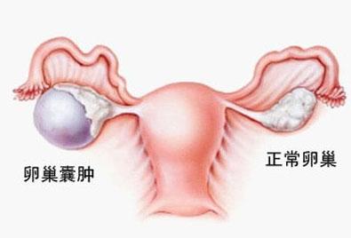 卵巢囊肿的治疗方法 卵巢囊肿能怀孕吗 卵巢囊肿的治疗方法是啥