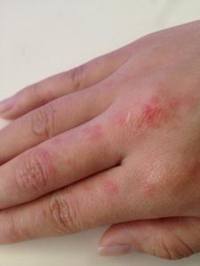 婴儿身上起小红点原因 手上有小红点 手上有红点 导致手上有红点的原因