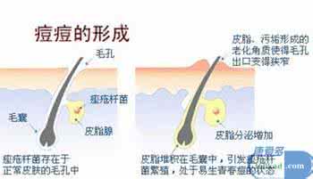 怎么杀灭痤疮杆菌 痤疮杆菌是什么 怎样彻底杀死痤疮杆菌