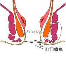 肛门瘙痒是什么回事 怀孕肛门痒是什么回事?