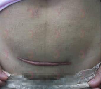 剖腹产疤痕增生有危害 剖腹产疤痕增生怎么办