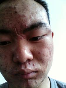 医治痤疮有效方法 如何医治脸上痤疮 什么方法呢