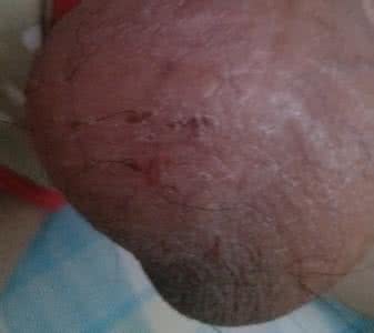 阴囊肿大的原因 阴囊肿大 阴囊肿大的病变类型