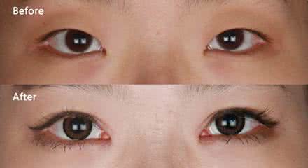 割双眼皮最好整形医院 哪里割双眼皮好 割双眼皮整形医院哪里好