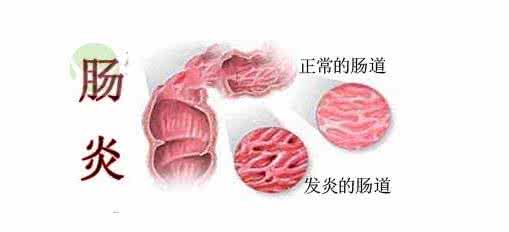 溃疡性直肠炎病因 溃疡性直肠炎病因 舌头溃疡的病因说明