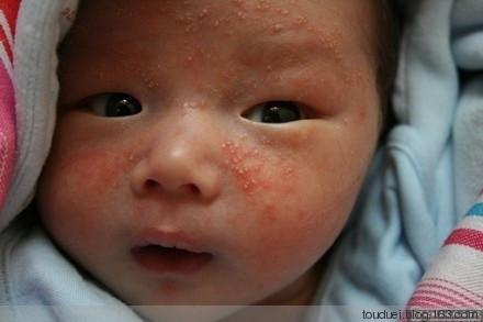 雅漾婴儿润肤霜 湿疹 宝宝湿疹用什么润肤霜 鹊肤保湿润肤 阶梯式治疗婴儿湿疹