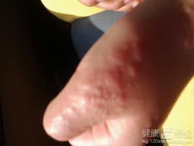 病毒性疱疹会传染吗 病毒性疱疹传染吗 病毒性疱疹怎么办