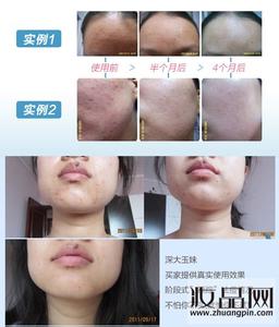 去痘痘的简单方法 去痘痘的简单方法 去痘痘的方法