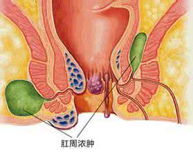 肛门湿疹导致肛周脓肿 肛周脓肿 肛门周围脓肿怎么办