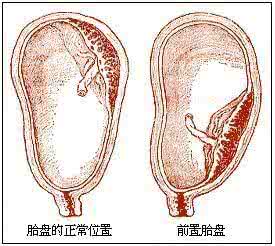 重型胎盘早剥的处理 重型胎盘早剥的处理 胎盘早剥的处理治疗方法