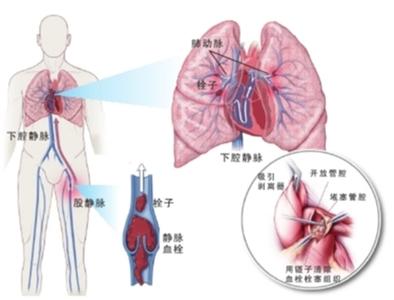 肺叶切除术 左肺下叶切除手术记录 左下肺叶切除术