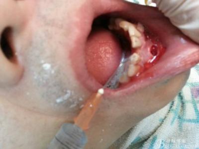 治湿尤效果好的方法 治疗湿尤效果好的方法 囊肿怎么治疗 这三种方法治疗囊肿效果好