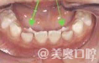 乳牙滞留的危害 成人乳牙滞留怎么办 乳牙滞留的危害有哪些?如何预防乳牙滞留?