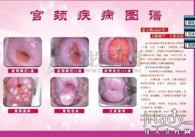 常见的妇科病有哪些 常见的妇科病有哪些 一般妇科病有哪些