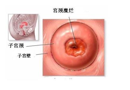 宫颈炎是宫颈糜烂吗 宫颈糜烂图片 宫颈炎图片