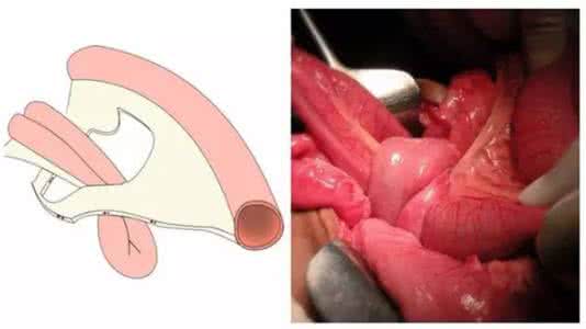 腹内疝的影像诊断 腹内疝的病因 这些病因你绝对不知道