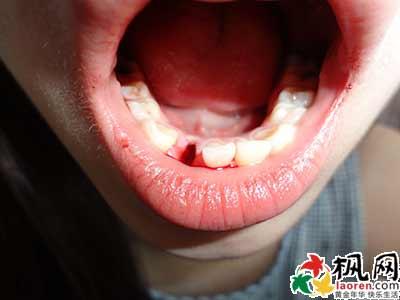 梦见牙齿掉了一颗上牙 梦见牙齿掉了一颗_梦见牙齿掉了一颗