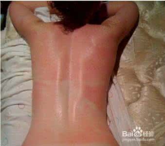 皮肤晒红了多久恢复 皮肤晒红了多久恢复 皮肤晒红了怎么恢复得快