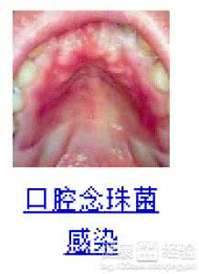 彻底治疗好过鹅口疮 怎样治疗鹅口疮好得快而且彻底