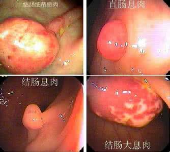 多发性结肠息肉 多发性结肠息肉布依族秘方