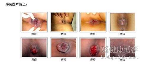 痔疮的病症 痔疮的病症 痔疮出来怎么办 正确治疗痔疮病症