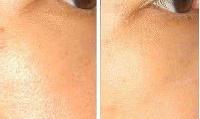 激素脸怎么排毒 橘皮脸怎么拯救 如何拯救你的激素脸?