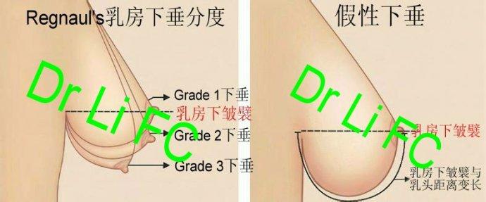 乳房下垂是什么原因 乳房下垂是什么原因 女性乳房下垂有哪些原因