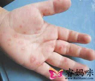 手足口病前期症状 手足口病 手足口病前期症状
